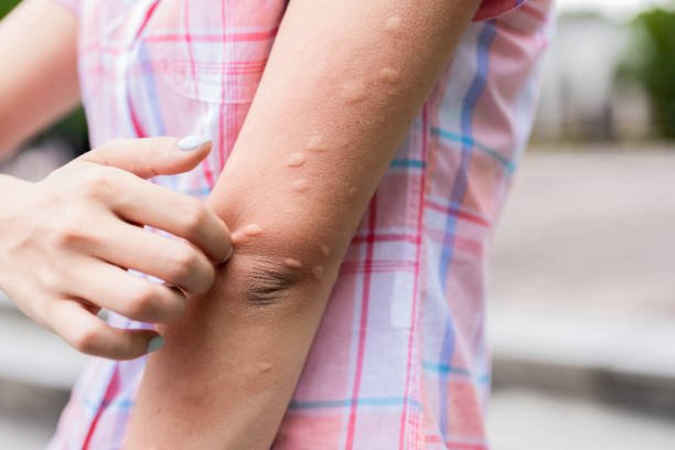 Fungal infections