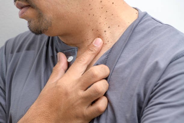 Warts, skin growth