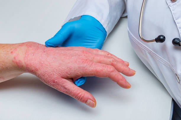 Chronic skin disease