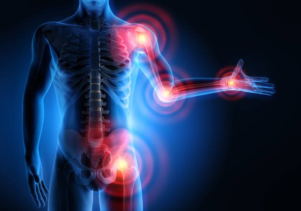 Osteo arthritis