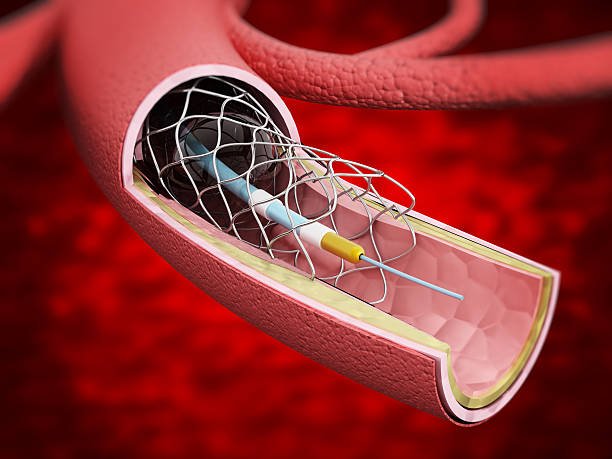 Cardiac Catheterization