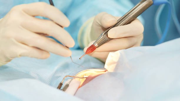Vitrectomy