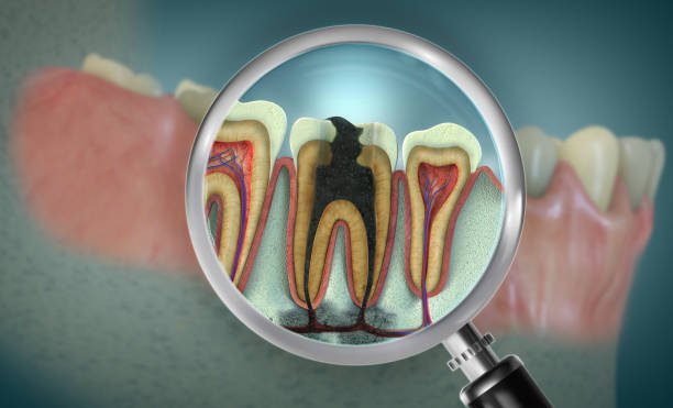 Root Canal Therapy